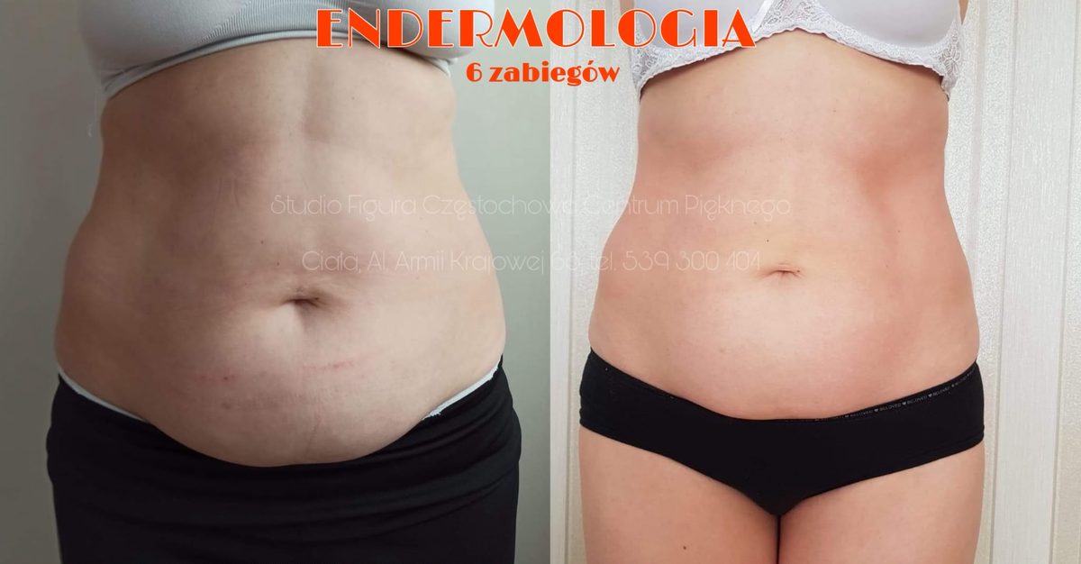Endermologia LPG Częstochowa – efekty przed i po 6 zabiegach: brzuch