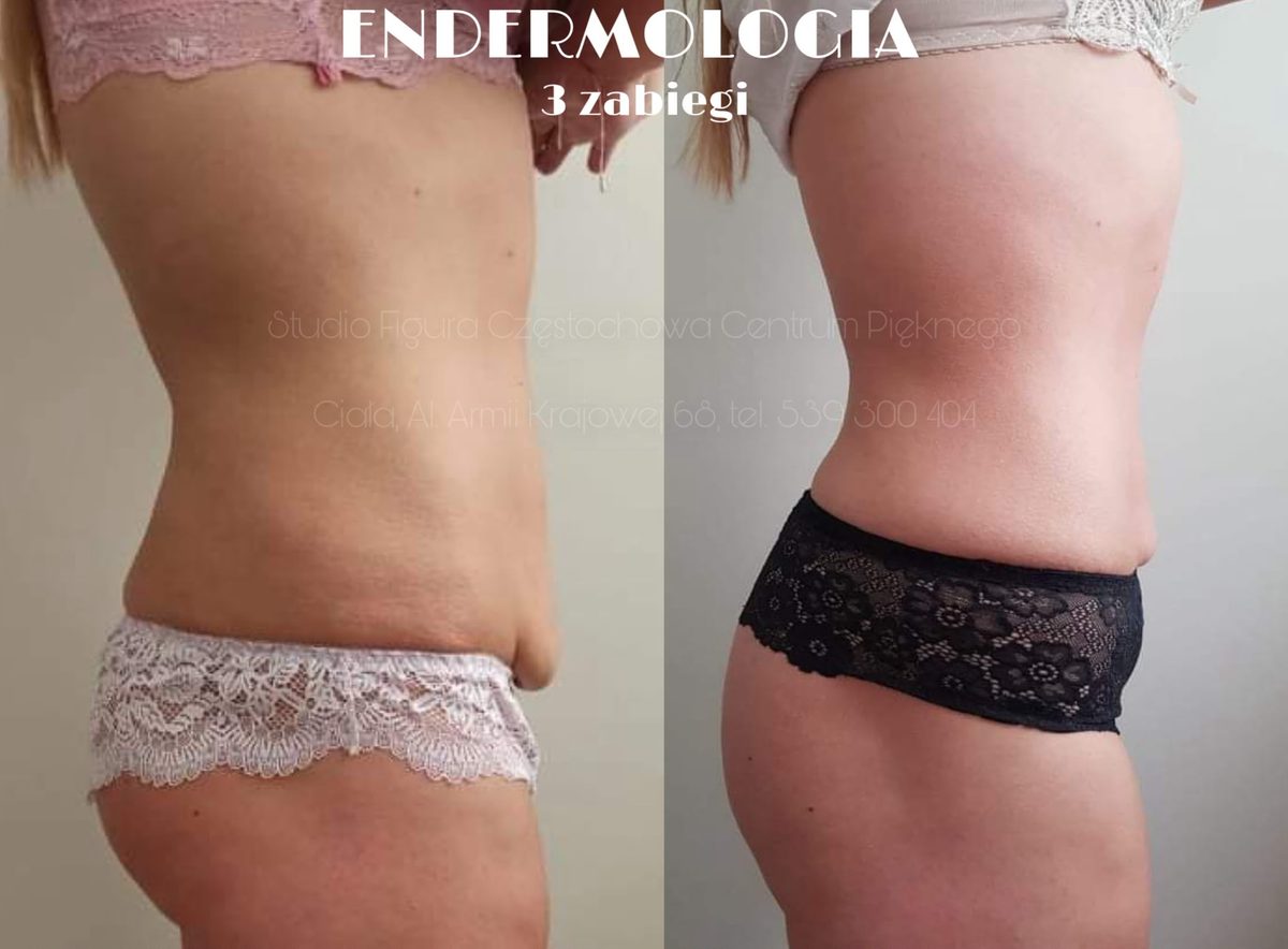 Endermologia LPG Częstochowa – efekty przed i po 3 zabiegach: brzuch i talia