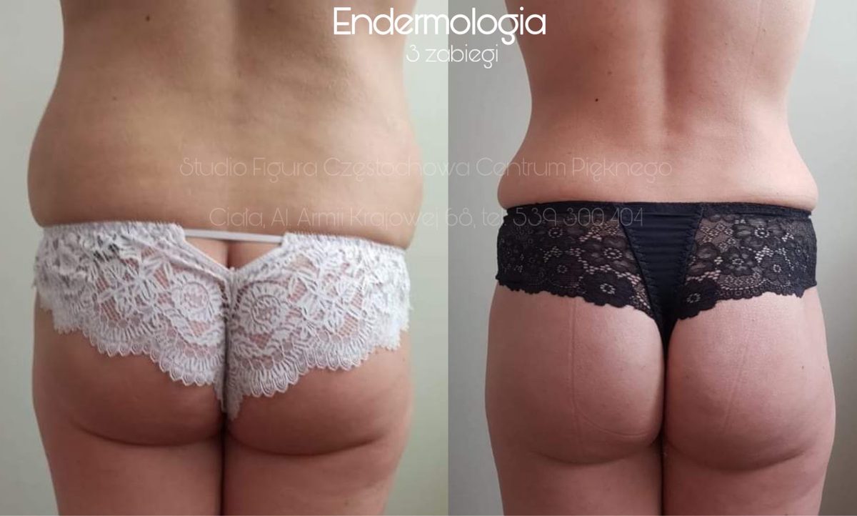 Endermologia LPG Częstochowa – efekty przed i po 3 zabiegach: pośladki