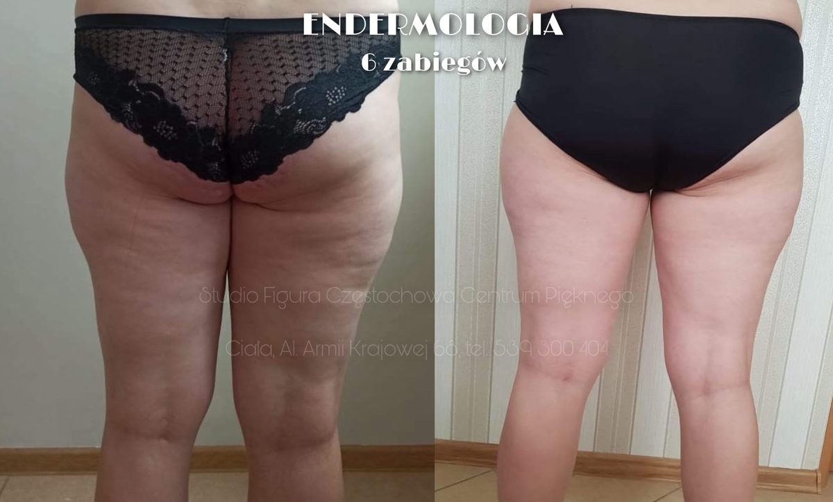 Endermologia LPG Częstochowa – efekty przed i po 6 zabiegach: uda i pośladki